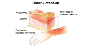 Ожог второй степени