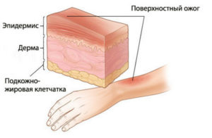 Повреждение от ожогов